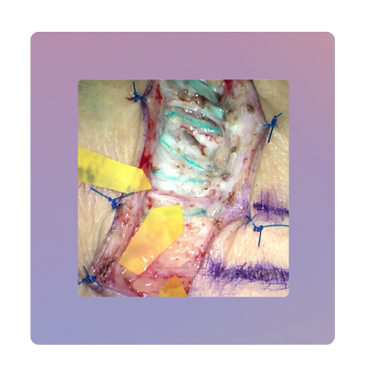 Gefärbte Lymphgefäße beim Menschen vor einer Lymphbahnwiederherstellung. Die Lymphgefäße wurden mit ICG angefärbt. In dem Bild ist die oberflächliche Lage der Lymphgefäße im menschlichen Körper zu erkennen.