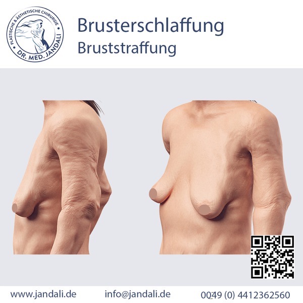 Brusterschlaffung_neu.jpg Brusterschlaffung neu