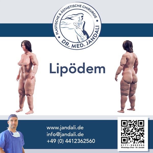 Lipödem 7 Kopie