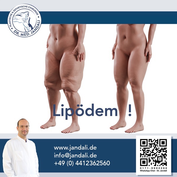 Lipödem2